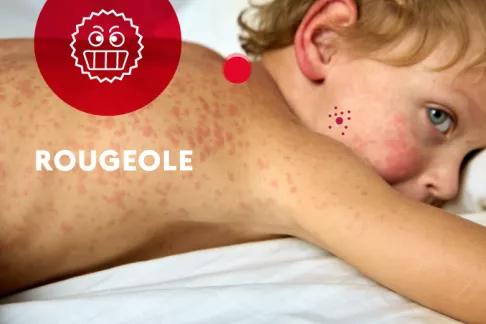 Rougeole