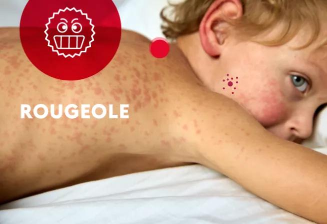 Rougeole